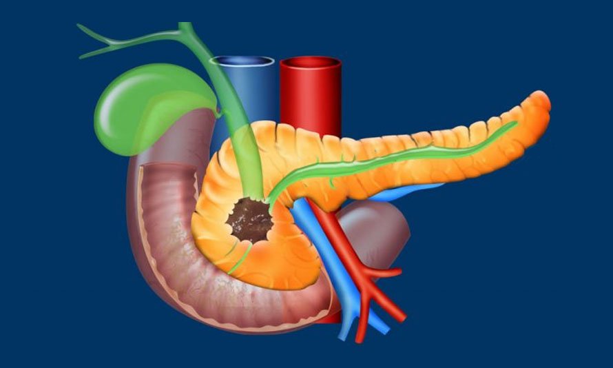 Pancreatic  Cancer/(Periampullary cancer)