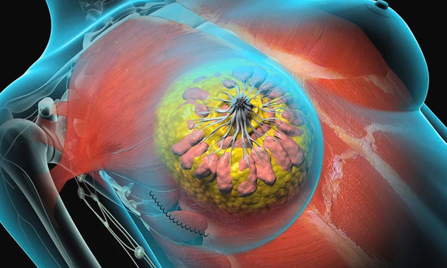 Breast cancer surgery