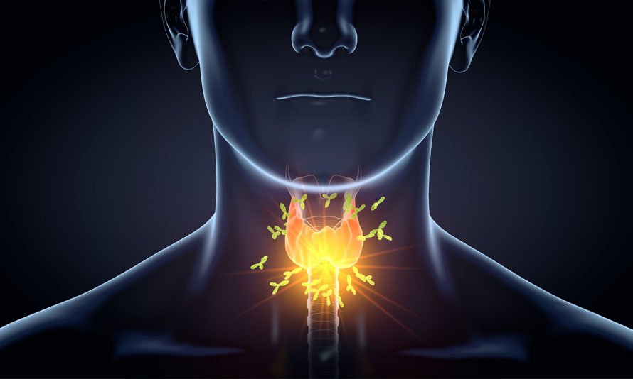 Thyroid cancer