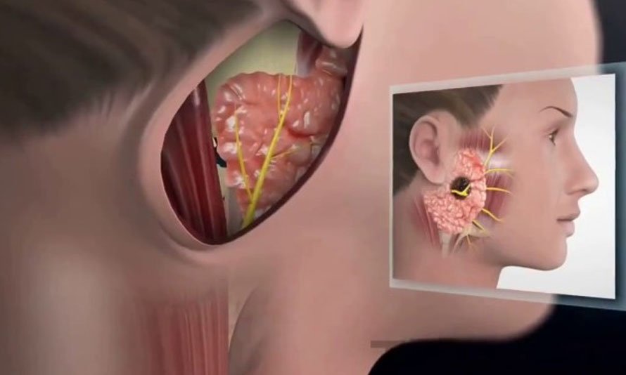 Parotid cancers