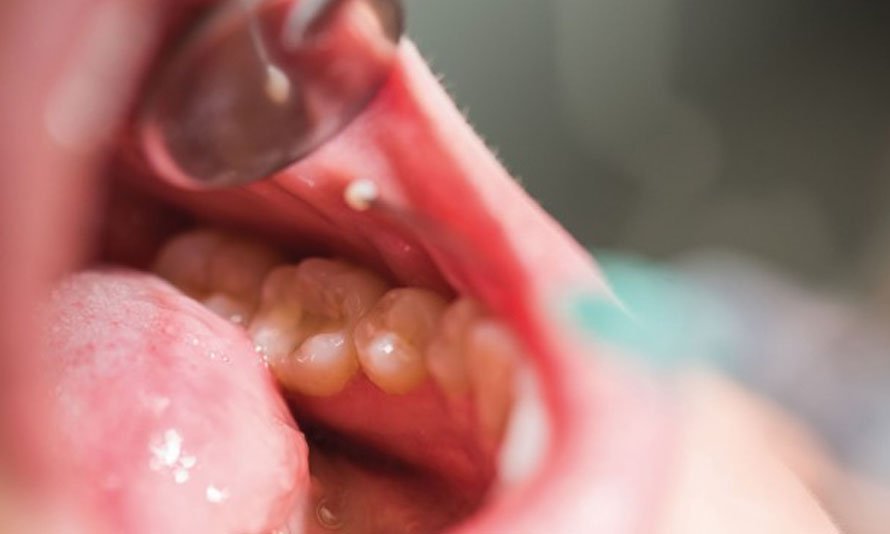 Oral Cavity Cancers