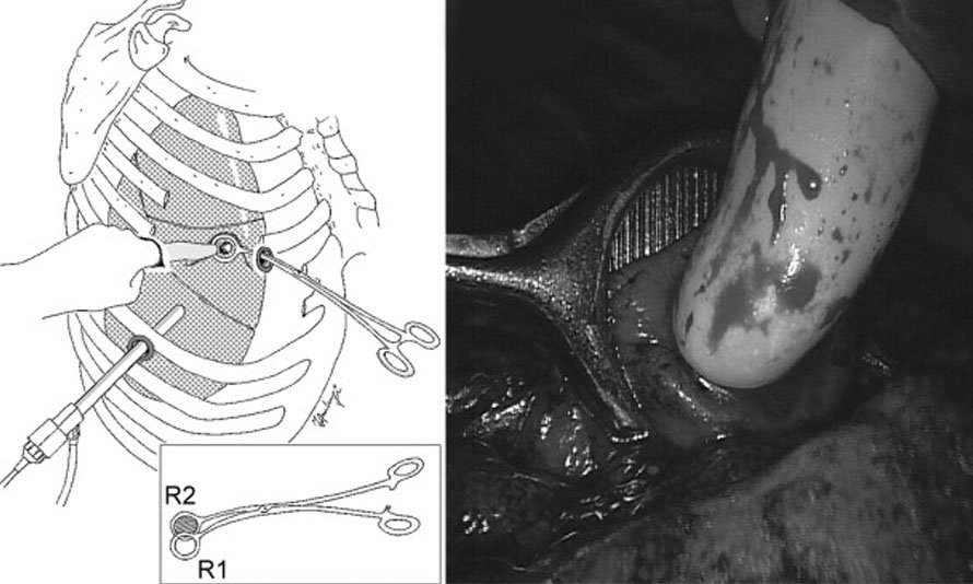 Pulmonary Metastatectomy