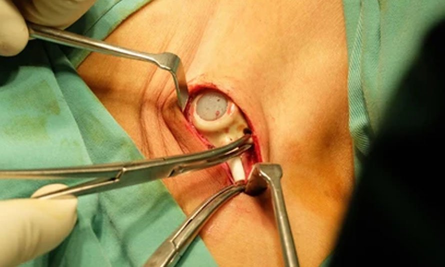 Chemoport placement