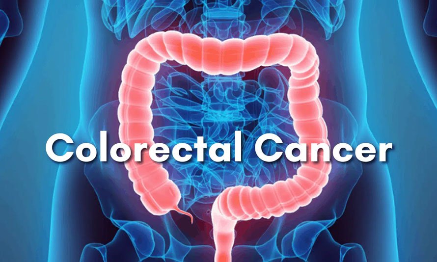 Colorectal Cancer Surgeries
