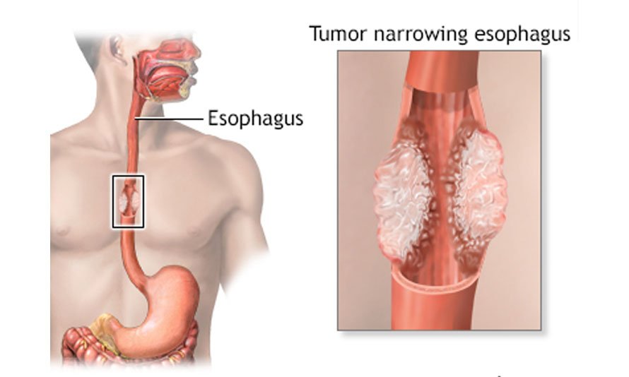 Esophageal Cancers