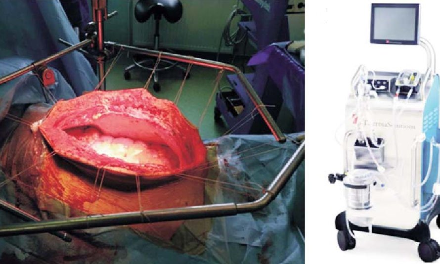 Cytoreductive surgery + HIPEC ( Hyperthermic Intraperitoneal Chemotherapy)