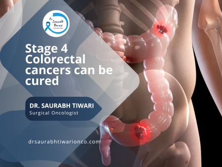 Stage 4 Colorectal cancers can be cured