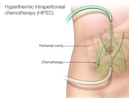 What cancers can be treated with Cytoreductive surgery and HIPEC?