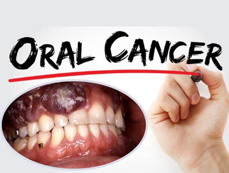 What is oral cancer ?