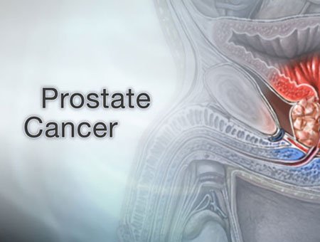 Prostate cancer